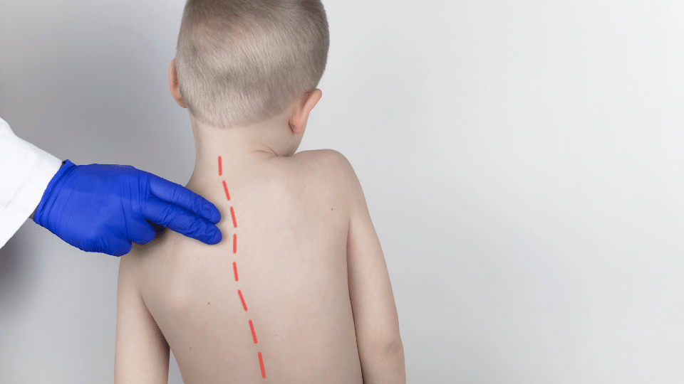 ¿Sabes si tu hijo tiene escoliosis? | Cómo detectar la escoliosis en niños y adolescentes