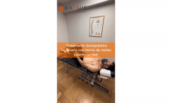 ¿Cómo aliviar el dolor de una hernia de núcleo pulposo lumbar? | La quiropráctica te puede ayudar